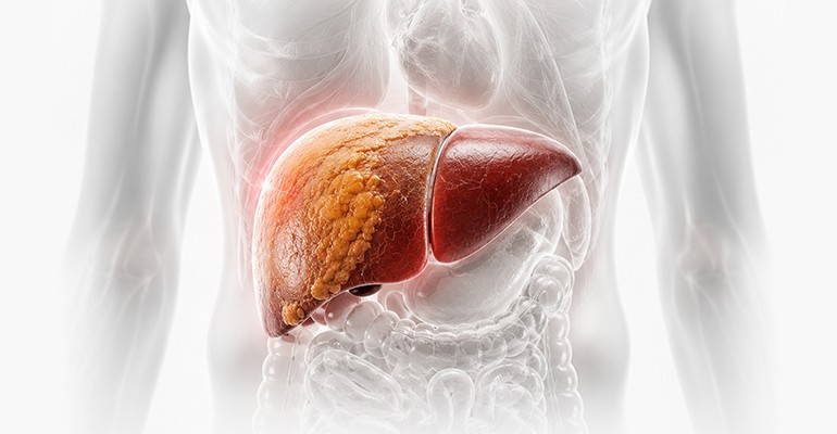 Fatty Liver
